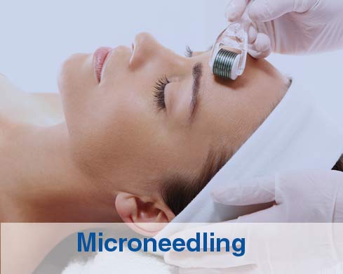 Stock image of a woman undergoing microneedling service